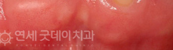 치과 잇몸치료 비용? 엠도게인 잇몸재생 사례 관련 이미지 39