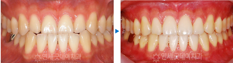 반대교합 교정 (30대 남성, 비발치) 관련 이미지 11