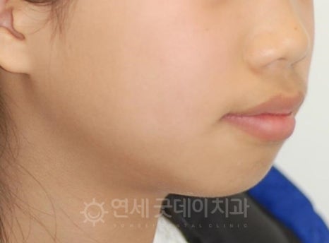 돌출입 무턱 치아교정 (15세 중학생) 관련 이미지 1