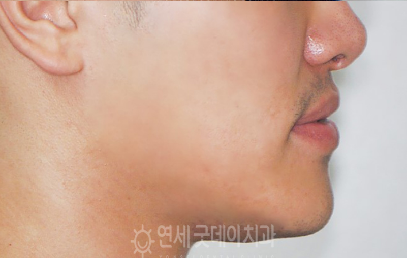 반대교합 교정 (30대 남성, 비발치) 관련 이미지 2