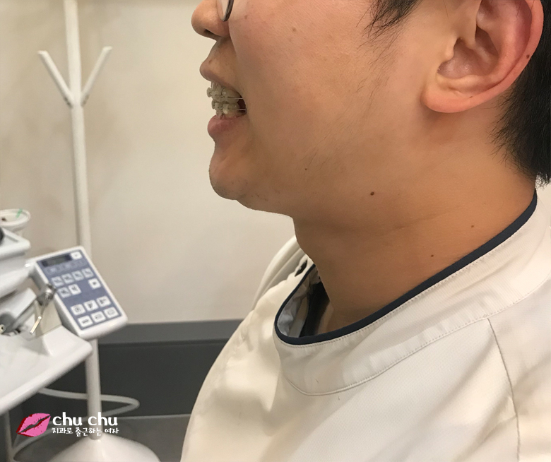 남자돌출입교정전후 - 지금도 ing 관련 이미지 1