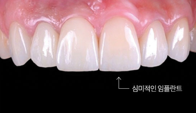 연세굿데이치과, 임플란트 권위자 박정철 교수님 초빙소식 :) 관련 이미지 4