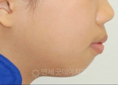 돌출입 무턱 치아교정 (15세 중학생) 관련 이미지 2