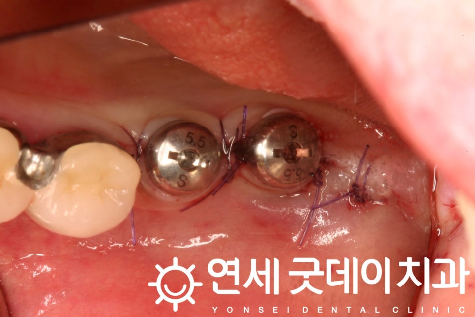 연세굿데이치과, 18년 장기보존 임플란트 증례발표 관련 이미지 6