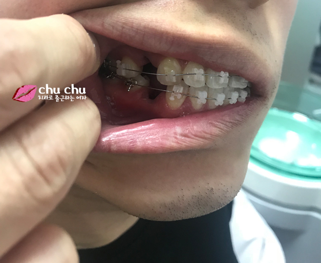 양재역 연세굿데이 - 하악 교정장치 붙이기까지 완료 !! 관련 이미지 3