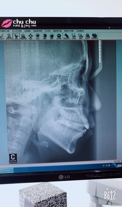 [ 연세굿데이 교정 ] 우리 직원이 달라졌어요 - 돌출입치아교정 start 관련 이미지 4