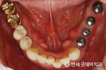 올 해 7월부터 65세 이상 어르신 틀니, 임플란트 보험 적용 ( 2016년 7월 1일부터 ) 관련 이미지 2