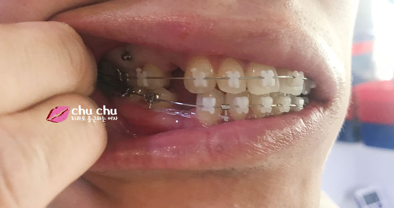 [ 교정4개월 ] 치아교정 파워체인 상/하악 모두 완료 관련 이미지 4