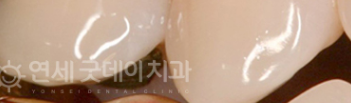 치과 잇몸치료 비용? 엠도게인 잇몸재생 사례 관련 이미지 30