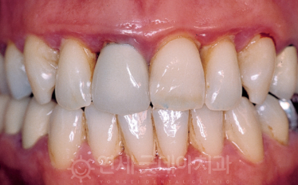 치과 잇몸치료 비용? 엠도게인 잇몸재생 사례 관련 이미지 4