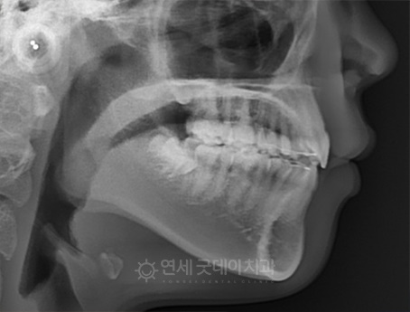 돌출입 무턱 치아교정 (15세 중학생) 관련 이미지 12