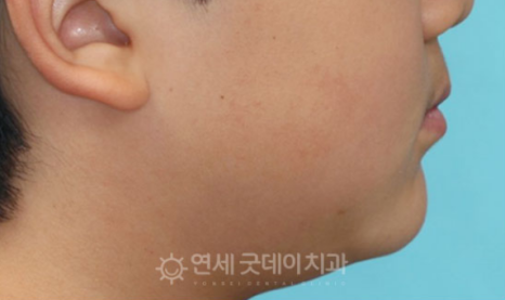 프리올소 장치안내 (ft. 어린이 부정교합 교정 편) 관련 이미지 14