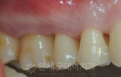 치과 잇몸치료 비용? 엠도게인 잇몸재생 사례 관련 이미지 7