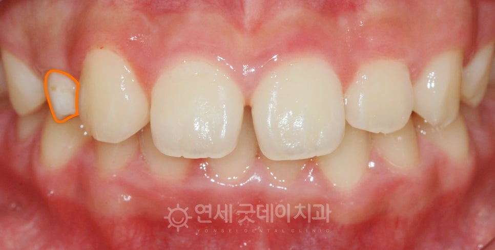 돌출입 무턱 치아교정 (15세 중학생) 관련 이미지 3