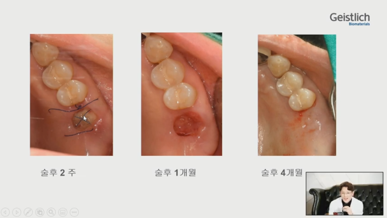[Dr.정재욱] 치조제보존술(ARP) 유튜브 실시간 온라인강연 관련 이미지 14