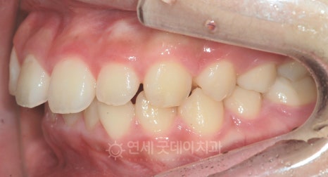 돌출입 무턱 치아교정 (15세 중학생) 관련 이미지 4