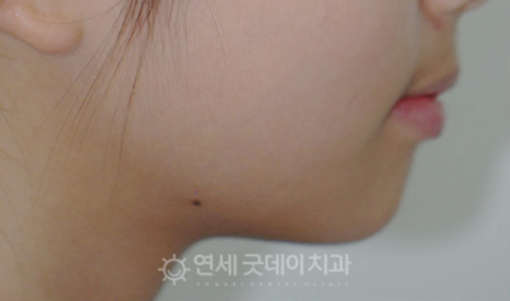 프리올소 장치안내 (ft. 어린이 부정교합 교정 편) 관련 이미지 16