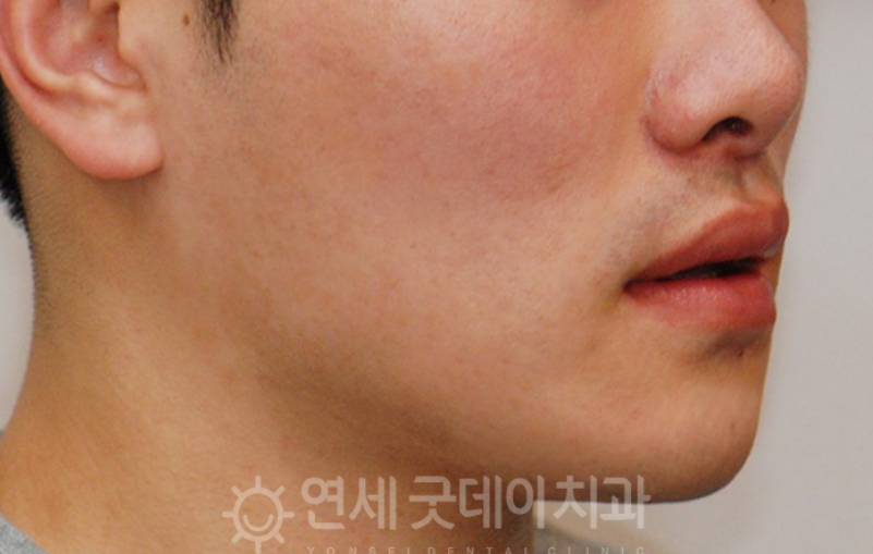 반대교합 교정 (30대 남성, 비발치) 관련 이미지 9