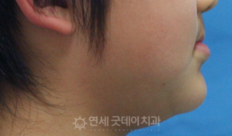 프리올소 장치안내 (ft. 어린이 부정교합 교정 편) 관련 이미지 13