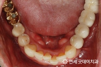 올 해 7월부터 65세 이상 어르신 틀니, 임플란트 보험 적용 ( 2016년 7월 1일부터 ) 관련 이미지 3