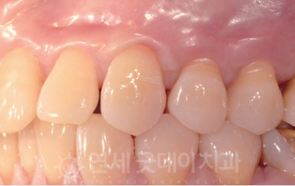 치과 잇몸치료 비용? 엠도게인 잇몸재생 사례 관련 이미지 6