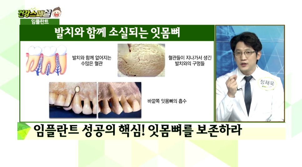 매일경제TV <건강스페셜> 임플란트 성공의 열쇠 - 정원장님 자문의 출연 관련 이미지 8