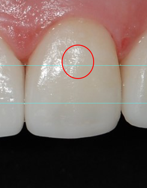 연세굿데이치과 기공세미나 PART 2. shade taking 관련 이미지 6