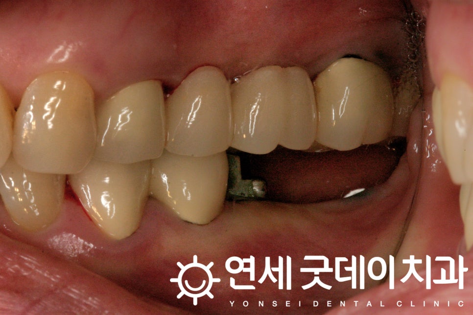 연세굿데이치과, 18년 장기보존 임플란트 증례발표 관련 이미지 4
