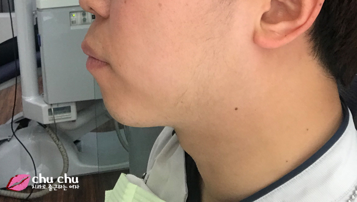양재역 연세굿데이 - 하악 교정장치 붙이기까지 완료 !! 관련 이미지 4
