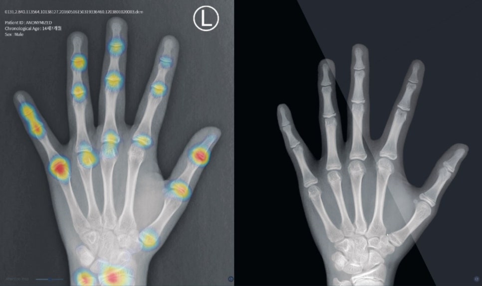 연세굿데이치과] 성장판 검사가 중요한 이유 관련 이미지 7