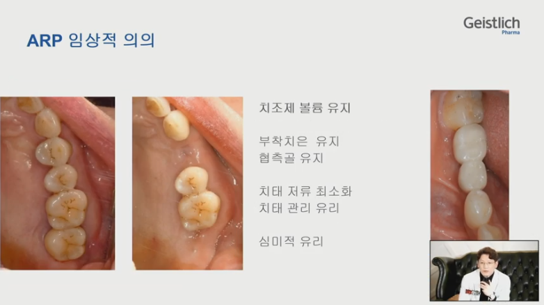 [Dr.정재욱] 치조제보존술(ARP) 유튜브 실시간 온라인강연 관련 이미지 16