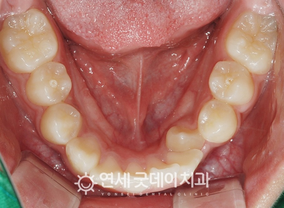 매복치아 견인교정 (feat. 구강외과 전문의 협진) 관련 이미지 4