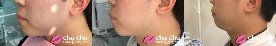 남자돌출입교정전후 - 지금도 ing 관련 이미지 4