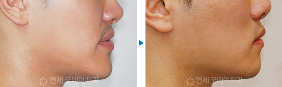 반대교합 교정 (30대 남성, 비발치) 관련 이미지 13