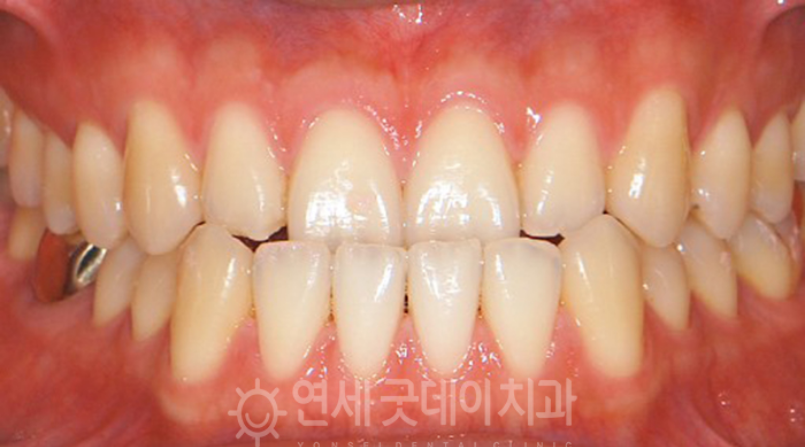 반대교합 교정 (30대 남성, 비발치) 관련 이미지 4