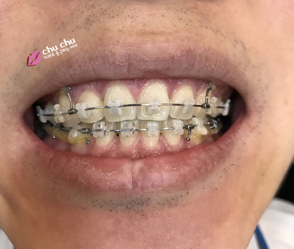 남자 돌출입교정일기 놀라운 변화! (1년, 365일 경과) 관련 이미지 4