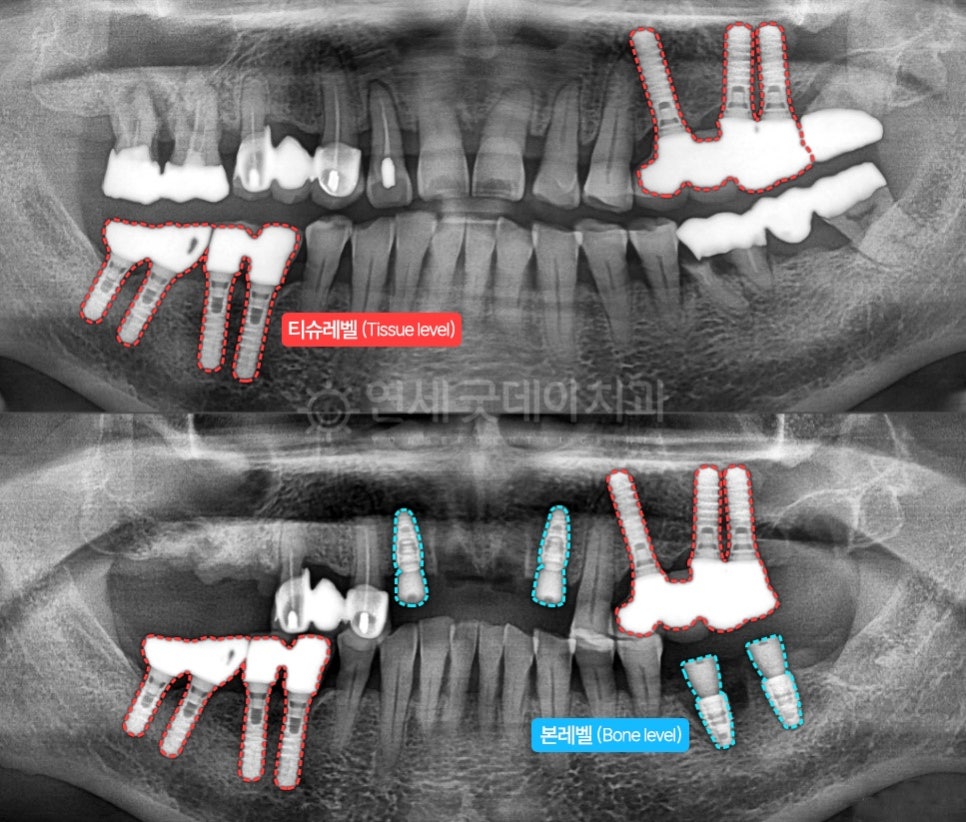 스트라우만 임플란트 권장대상 [Straumann] 관련 이미지 6