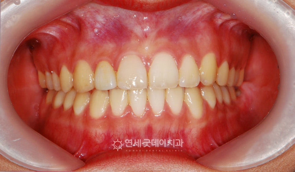 치아중심선 비대칭 교정 관련 이미지 5