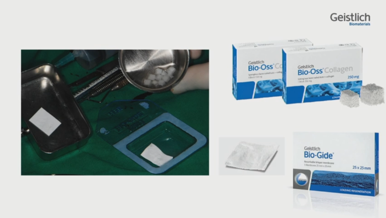 [Dr.정재욱] 치조제보존술(ARP) 유튜브 실시간 온라인강연 관련 이미지 17