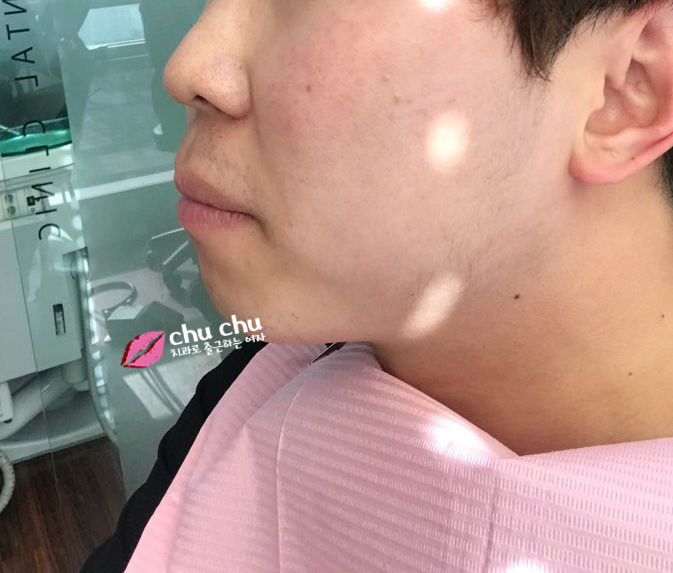 튀어나온 입 변화과정 (2018.03 ~) 관련 이미지 2