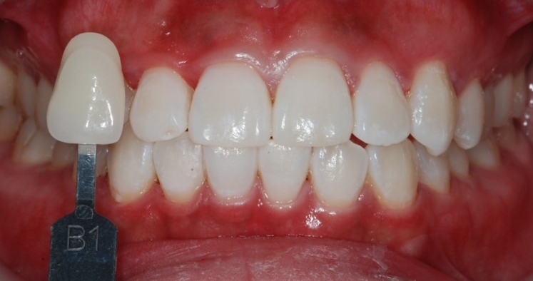 연세굿데이치과 기공세미나 PART 2. shade taking 관련 이미지 7