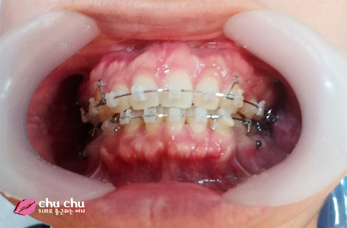 치아교정후기 2년간의 과정, 얼굴변화 (with 굿데이치과) 관련 이미지 8