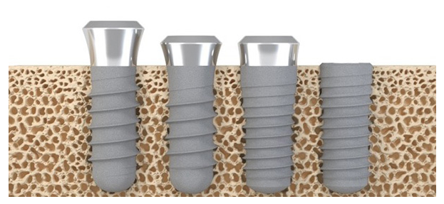 스트라우만 임플란트 권장대상 [Straumann] 관련 이미지 5