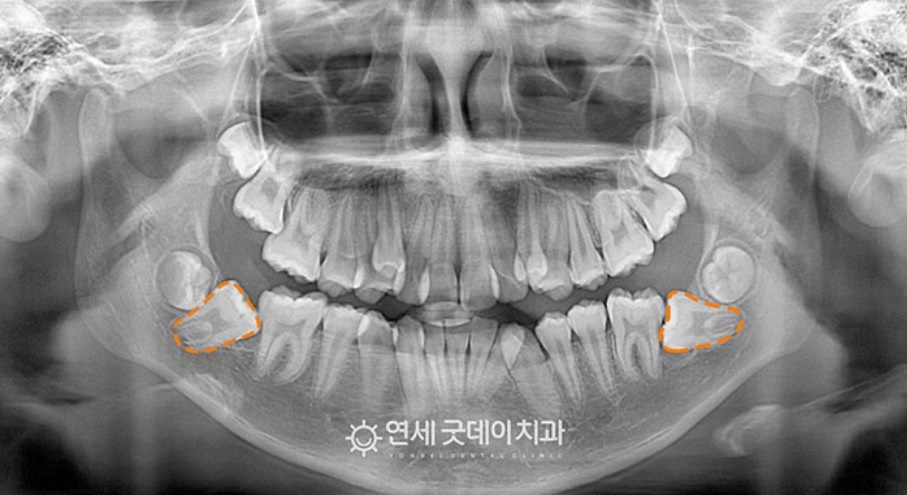 매복치아 견인교정 (feat. 구강외과 전문의 협진) 관련 이미지 5