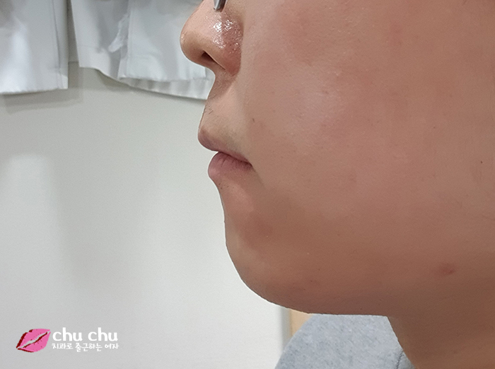 치아교정후기 2년간의 과정, 얼굴변화 (with 굿데이치과) 관련 이미지 13