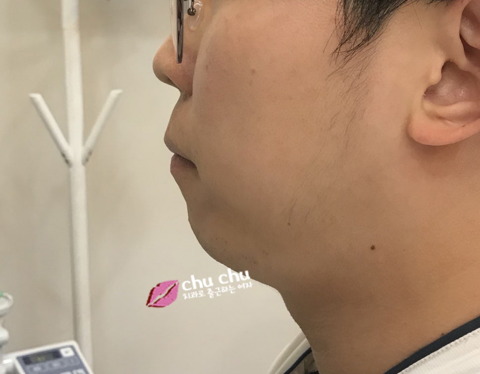 튀어나온 입 변화과정 (2018.03 ~) 관련 이미지 5