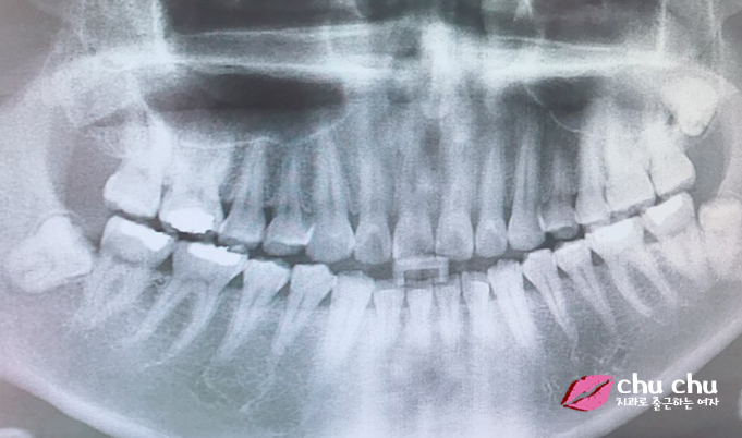 [ 연세굿데이 교정 ] 우리 직원이 달라졌어요 - 돌출입치아교정 start 관련 이미지 5