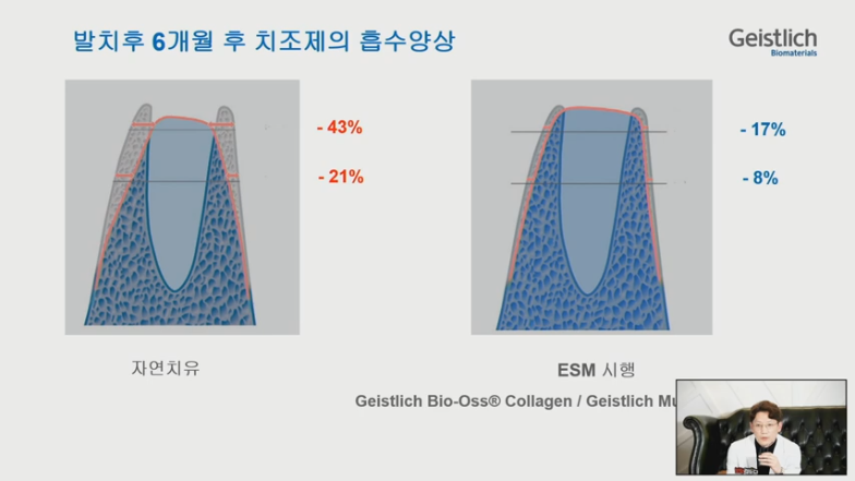 [Dr.정재욱] 치조제보존술(ARP) 유튜브 실시간 온라인강연 관련 이미지 13