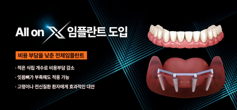 틀니 대안, 올온엑스(All-on-X) 시스템 도입 안내 관련 이미지 1