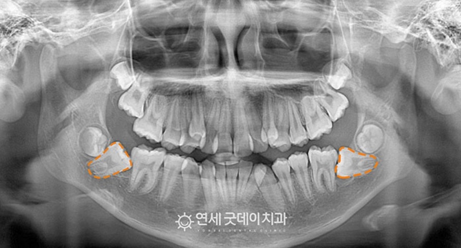 매복치아 견인교정 (feat. 구강외과 전문의 협진) 관련 이미지 14